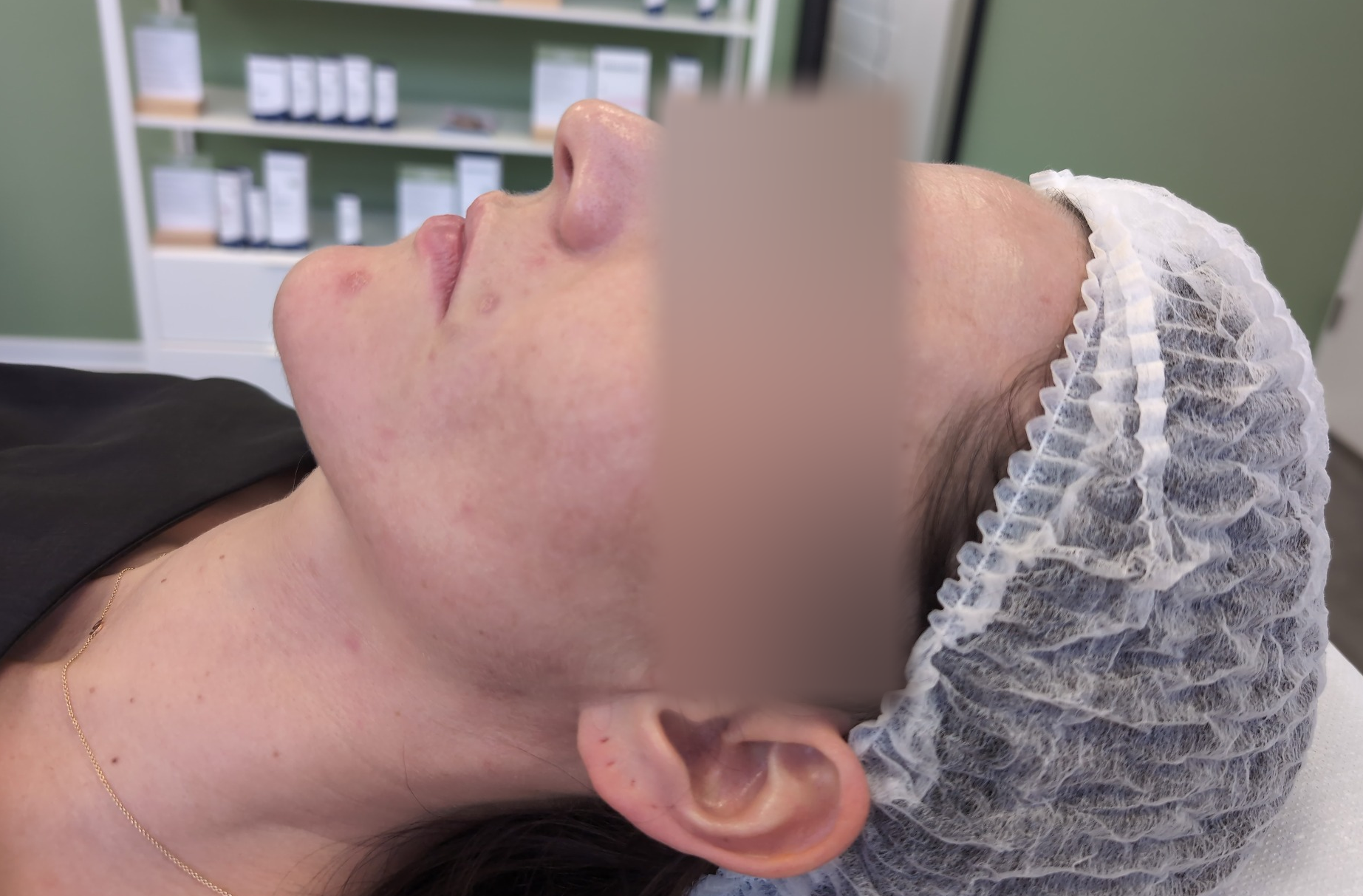 Acne en restvlekjes, na behandeling