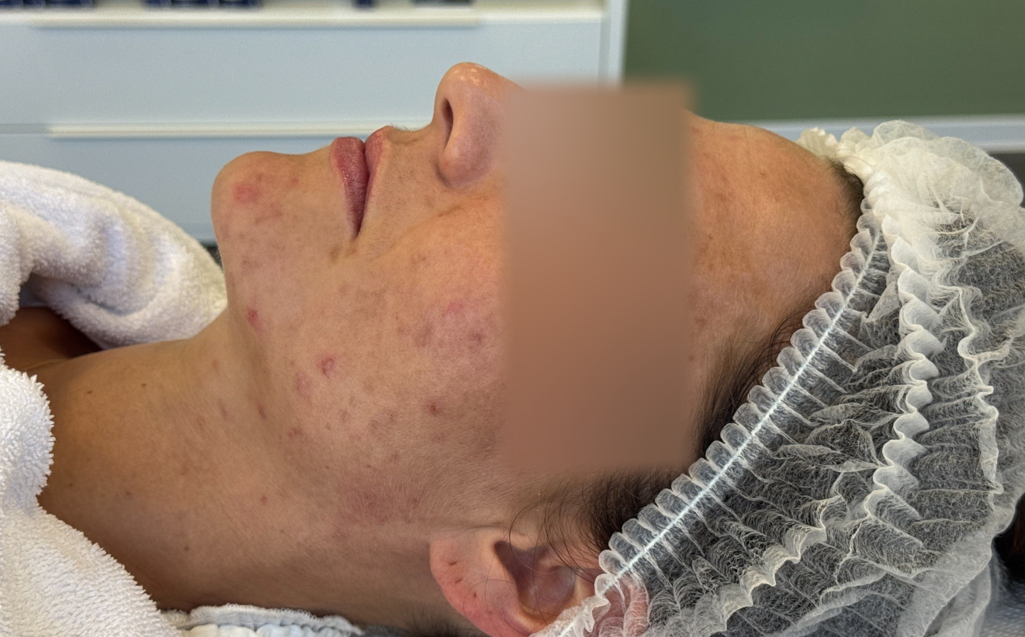 Acne en restvlekjes, voor behandeling