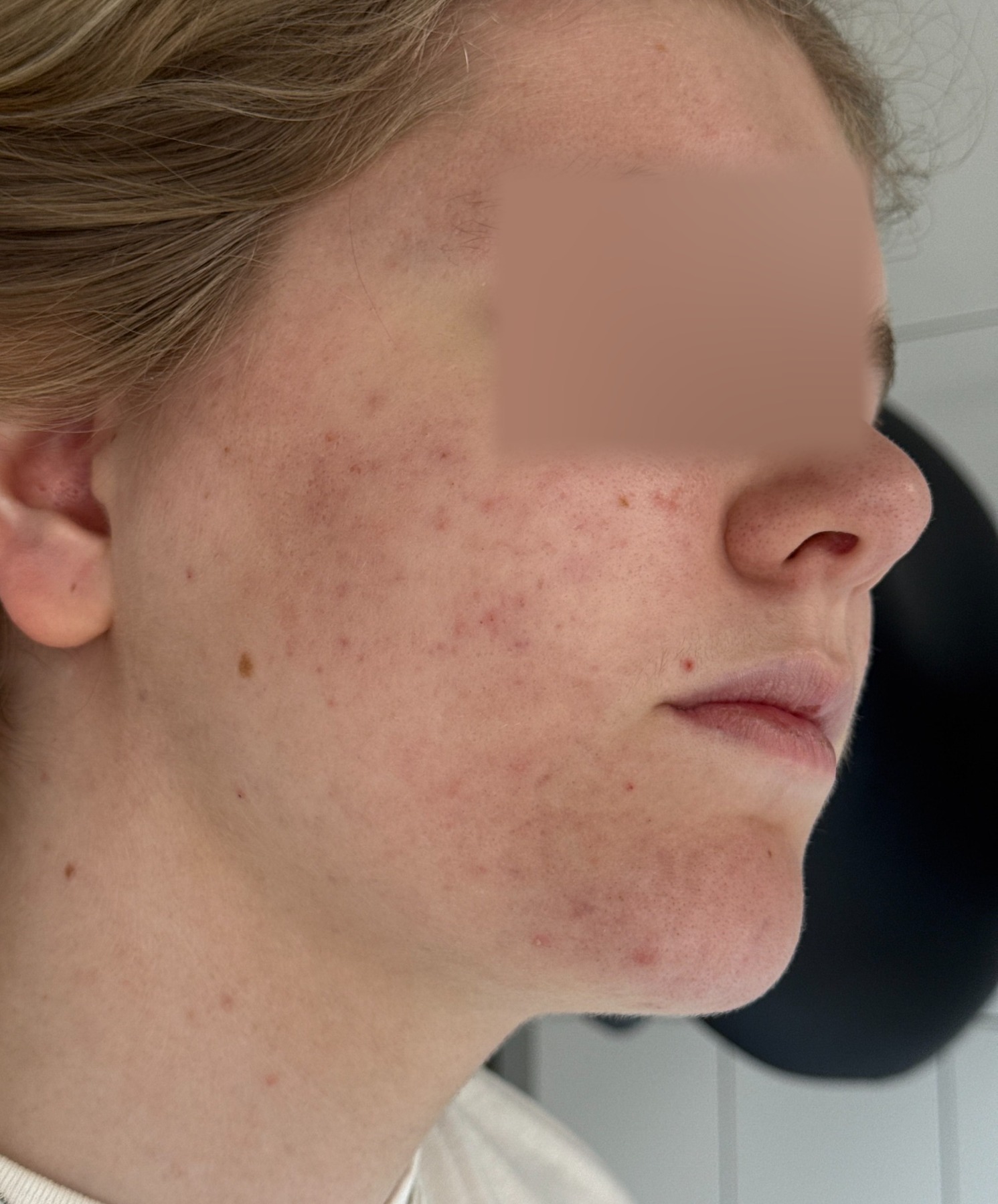 Actieve acne, na behandeling