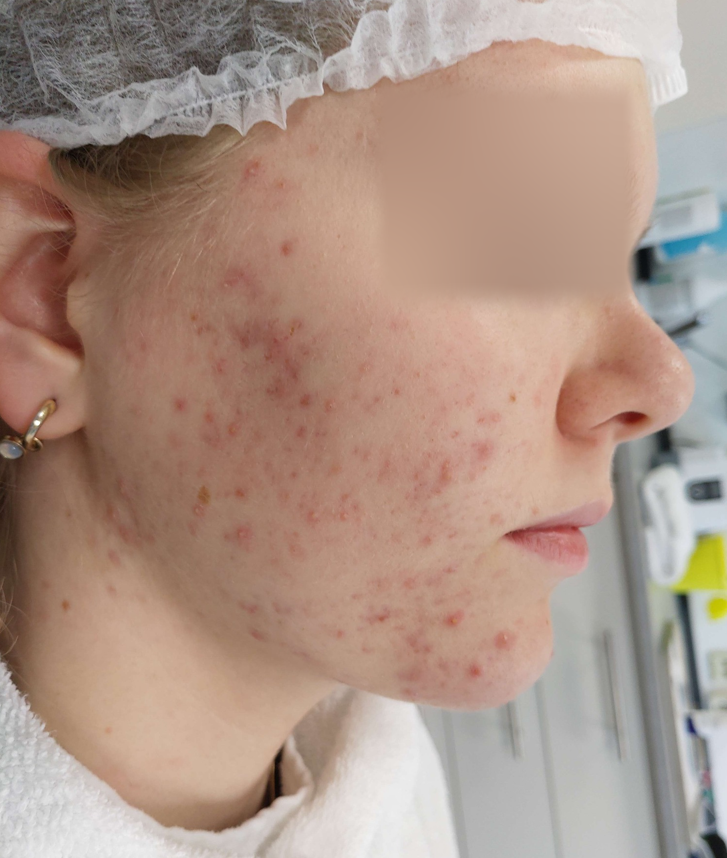 Actieve acne, voor behandeling