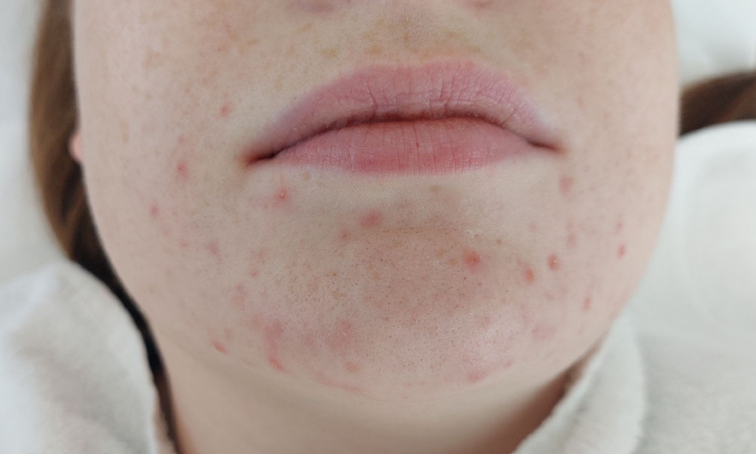 Acne rond de mond en kin, na behandeling