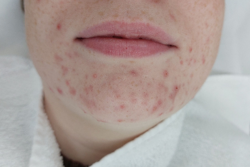 Acne rond de mond en kin, voor behandeling
