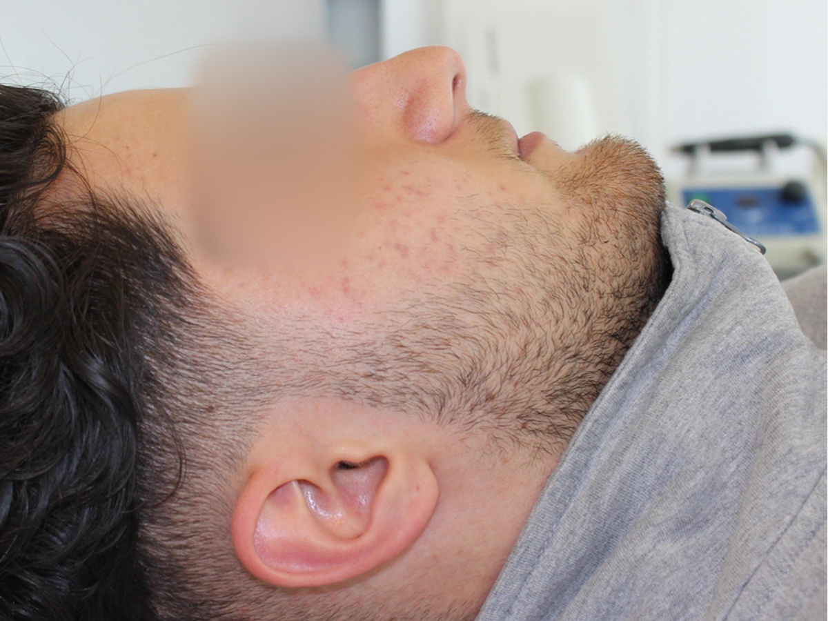 Acne en restschade, linkerwang, tussenresultaat na peelings en microneedling