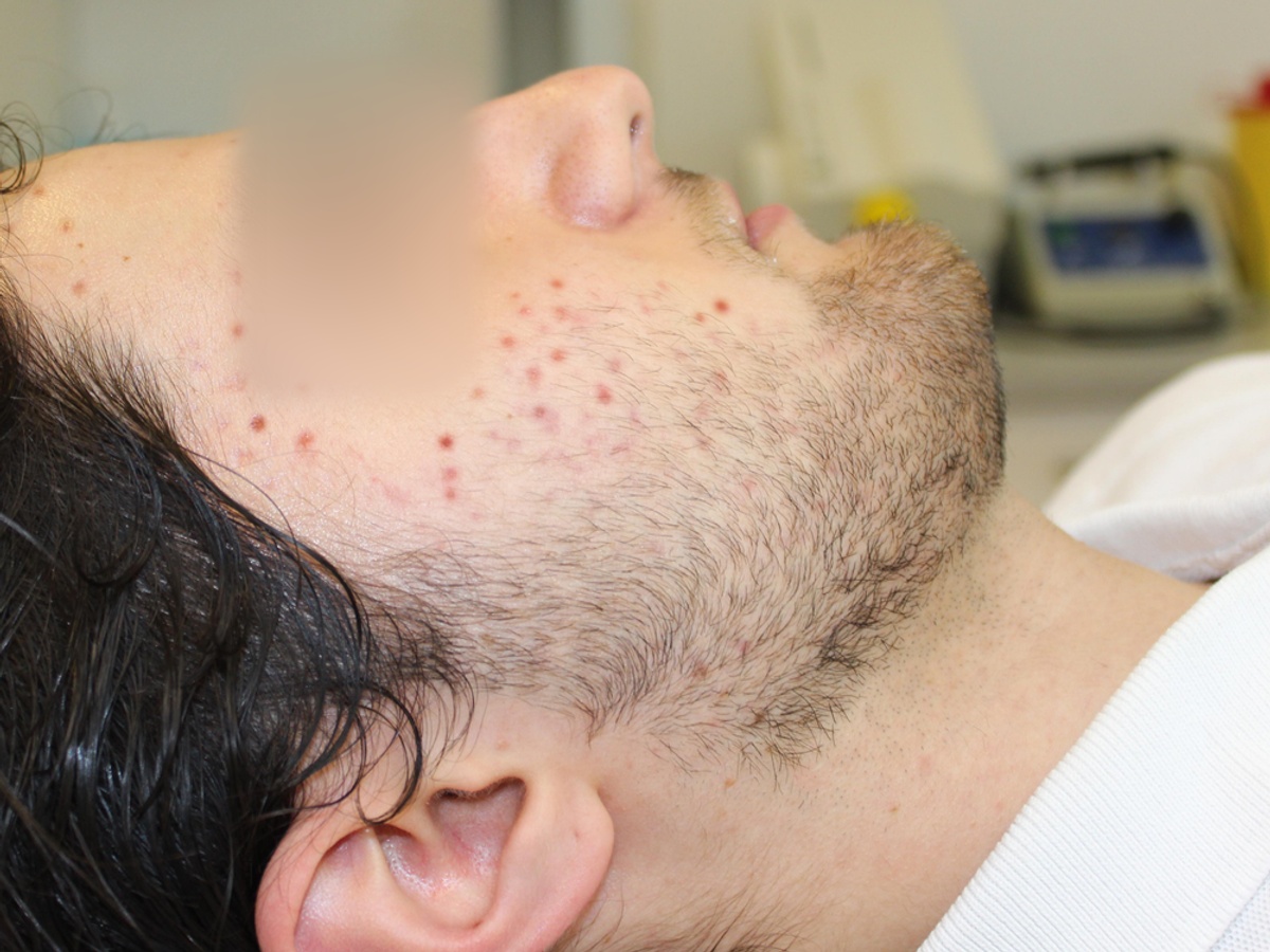 Acne en restschade, linkerwang, voor behandeling