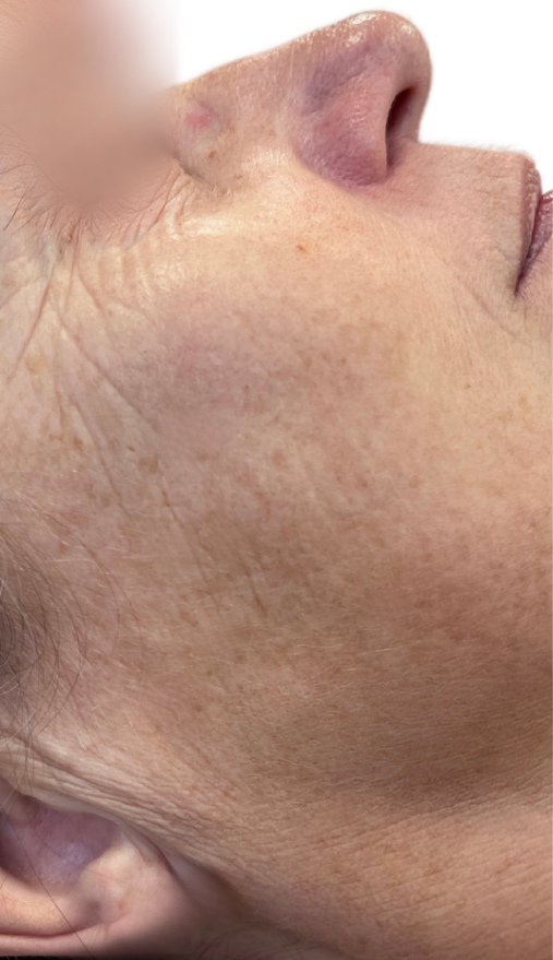 Gelaat vóór een combinatiebehandeling met IPL/VPL, skinboosters, peelings en LPG Endermologie.