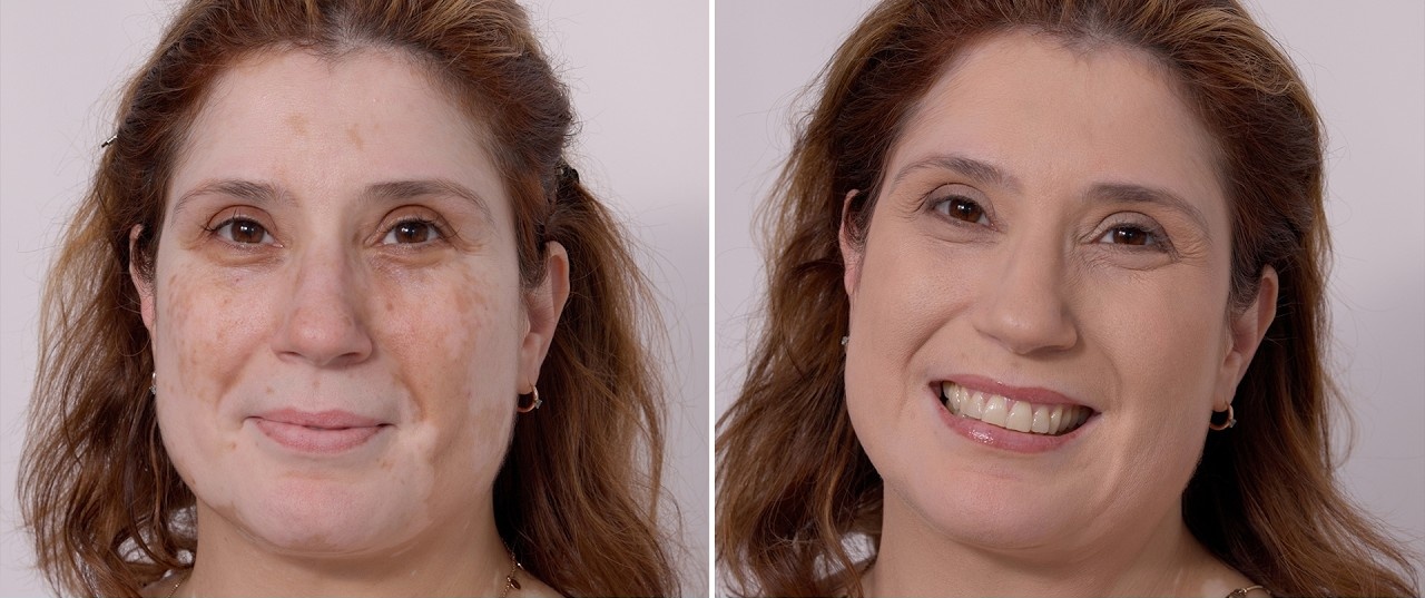Voor en na het aanbrengen van Dermacolor camouflage bij vitiligo