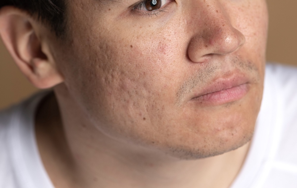 Close-up van een wang met zichtbare putjes en restvlekjes