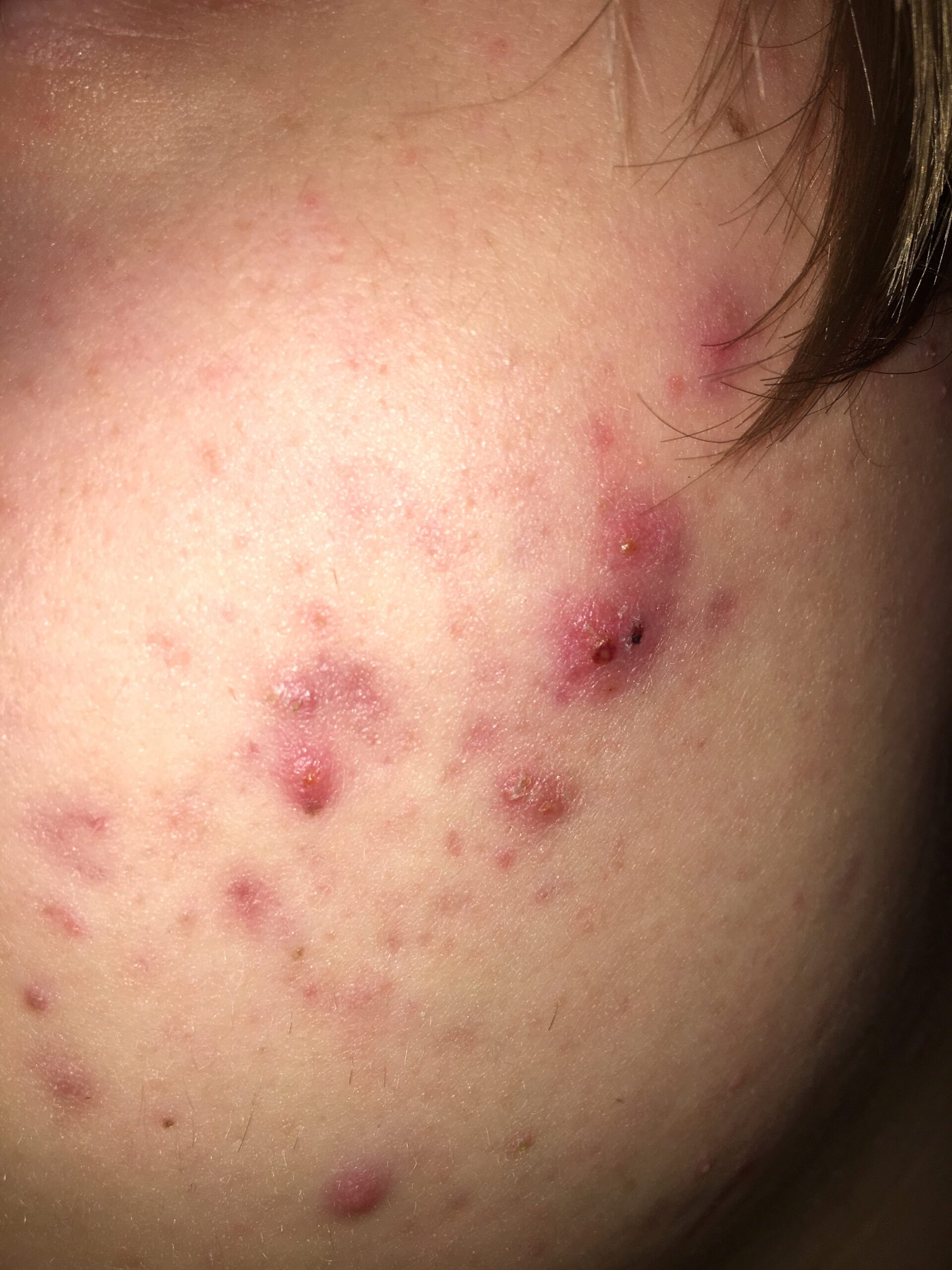Close-up van huid met rode puistjes