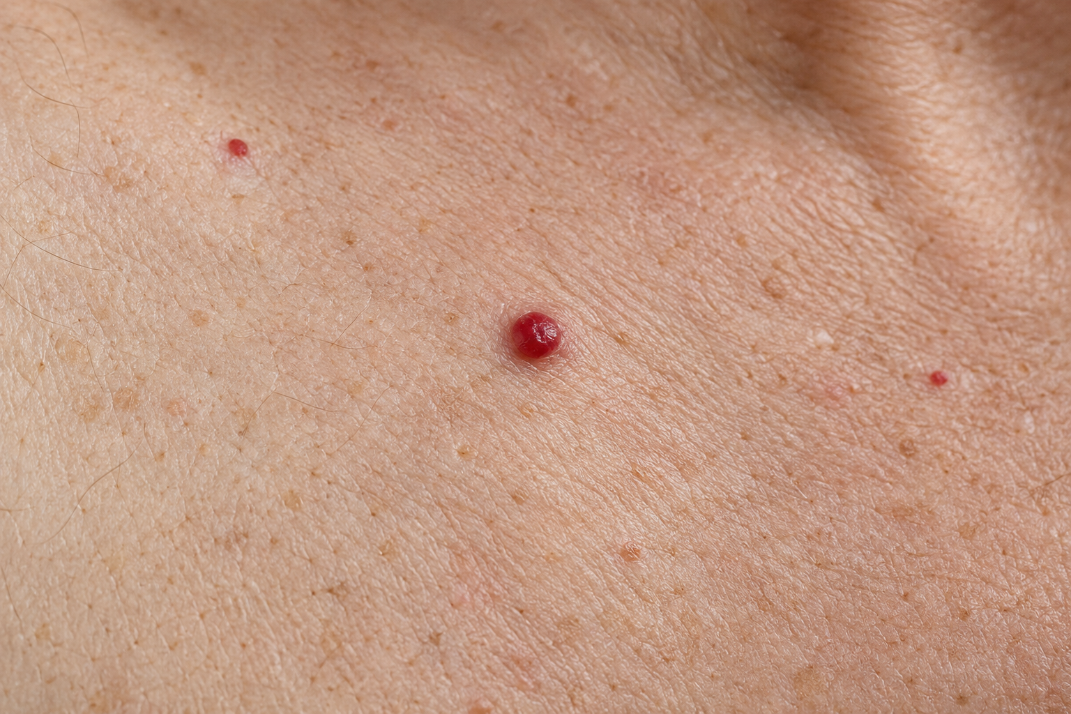 Close-up van een rood bloedblaasje op de huid