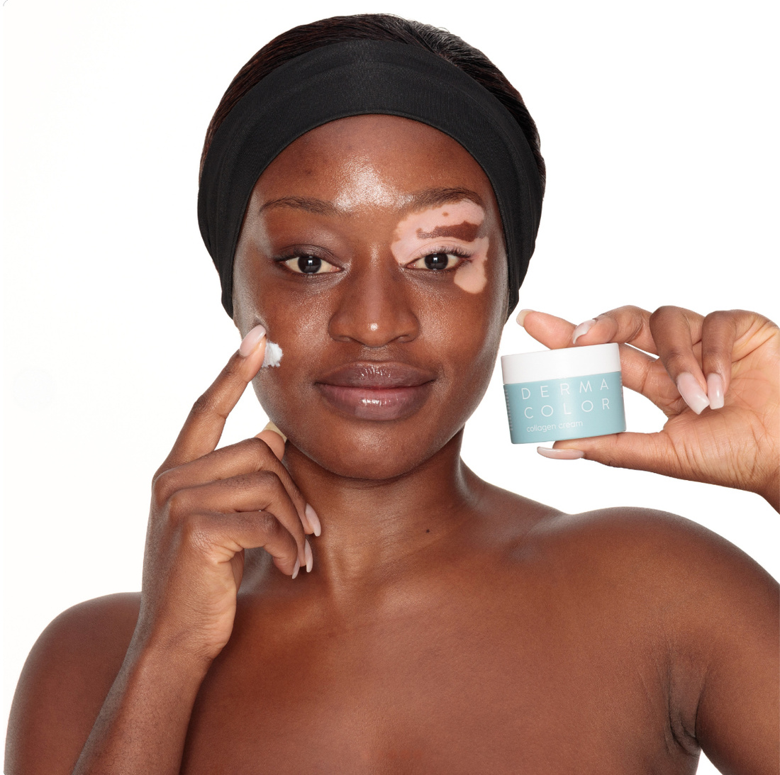 Zichtbare vitiligo vóór het aanbrengen van Dermacolor camouflage