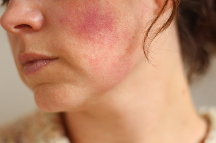 Roodheid van de gezichtshuid bij rosacea