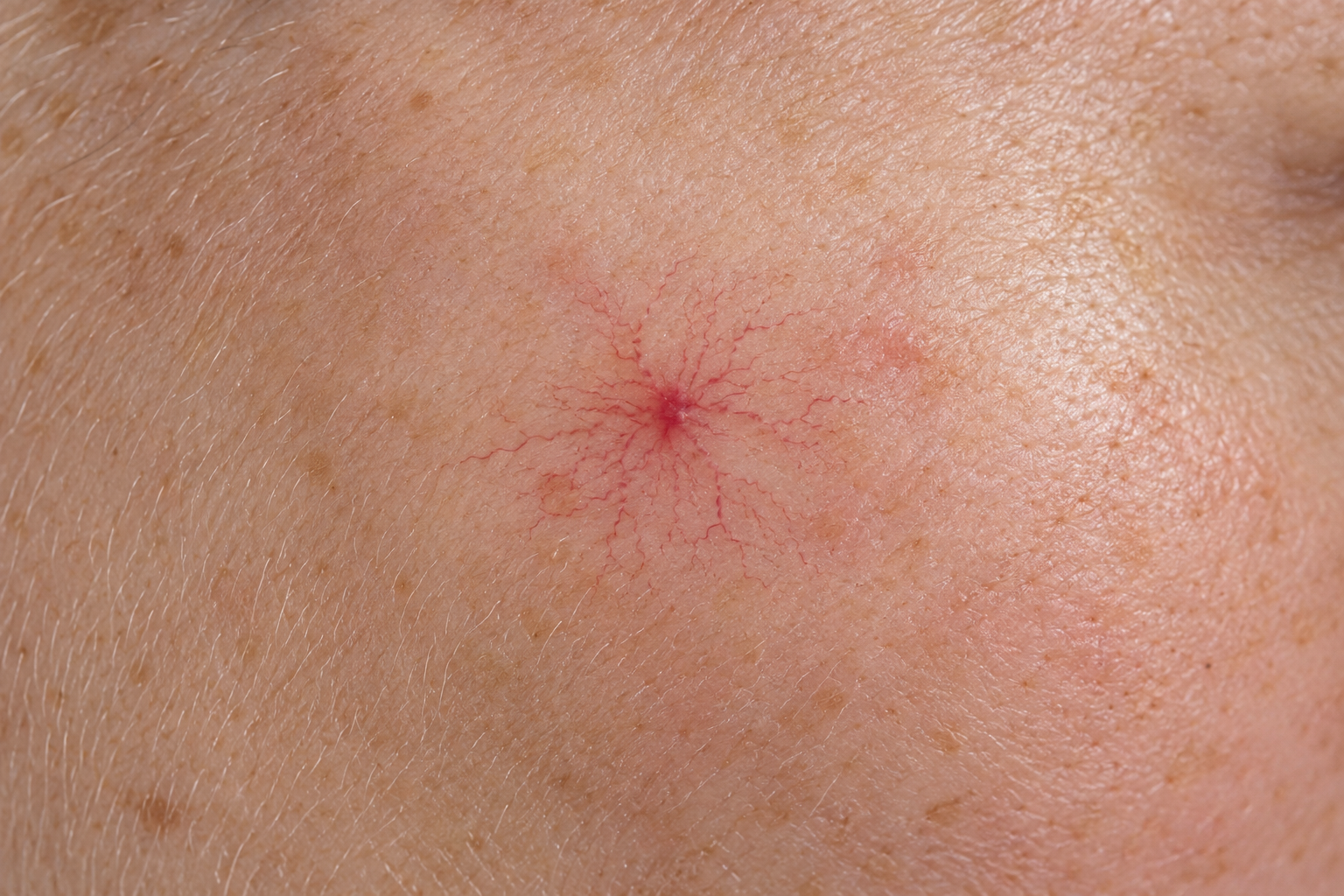 Close-up van een spinnekopje met fijne rode vaatjes op de wang