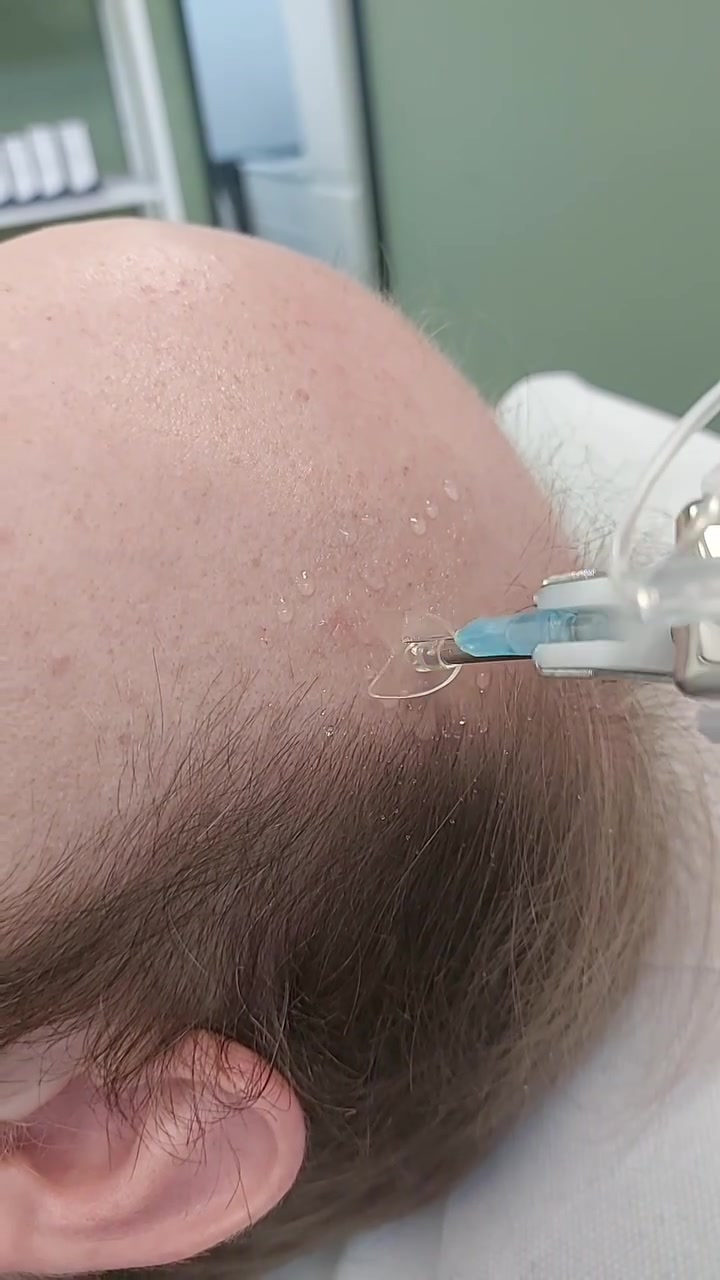 XL Hair wordt op de hoofdhuid toegepast met de U225