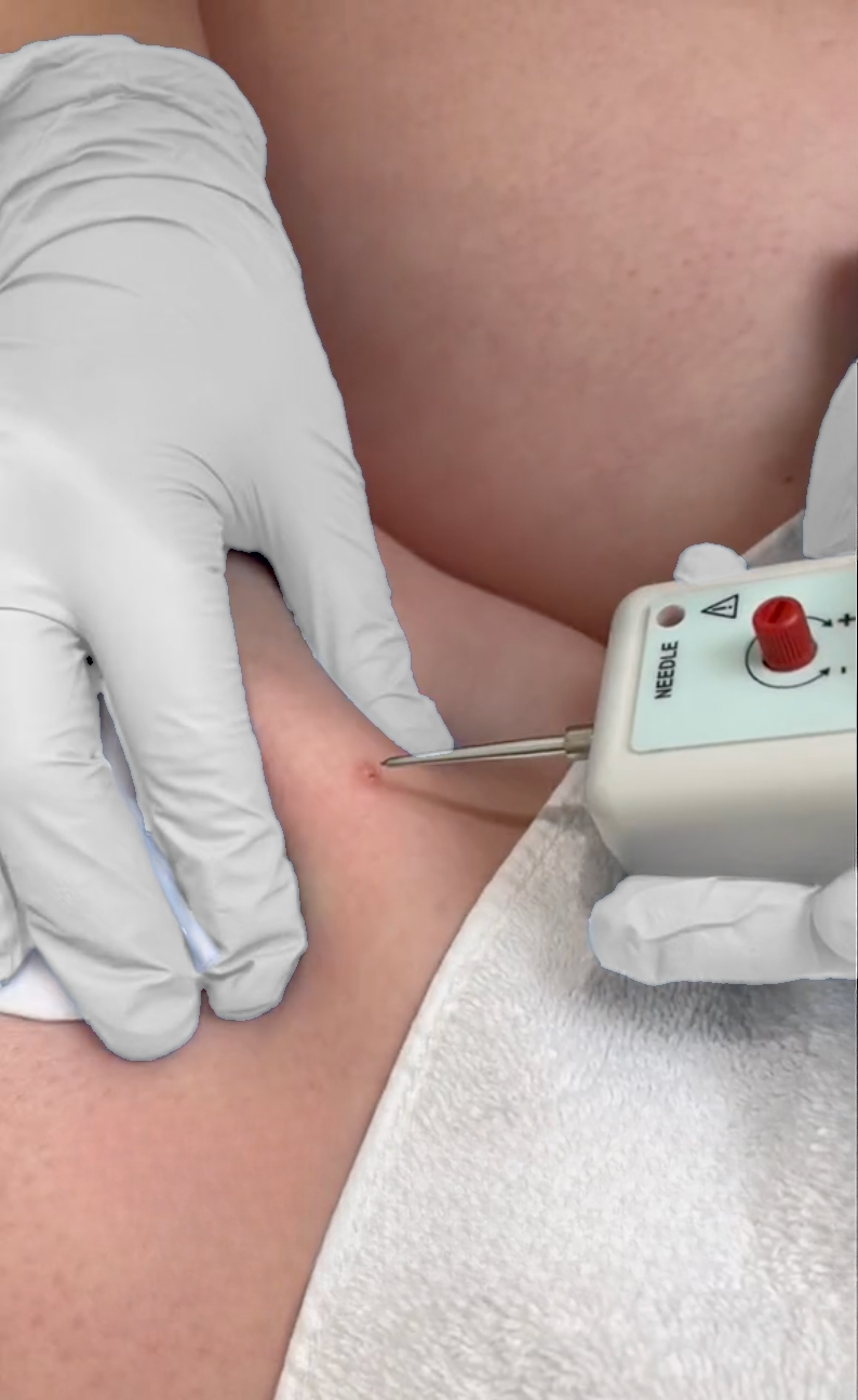 Coagulatie van een klein huidplekje met Zapper Medical