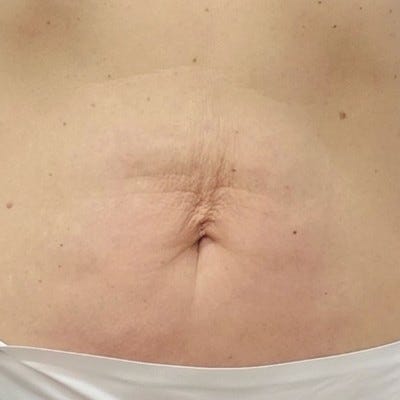 Buik en taille, na behandeling