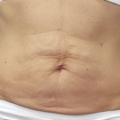 Buik en taille, voor behandeling