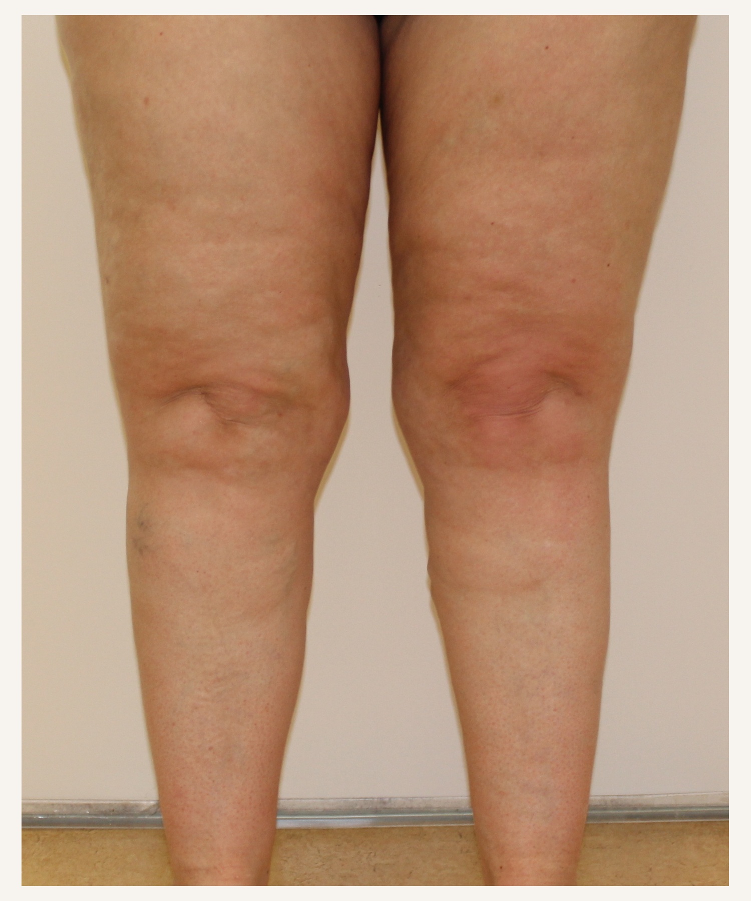 LPG Endermologie van de benen, na behandeling