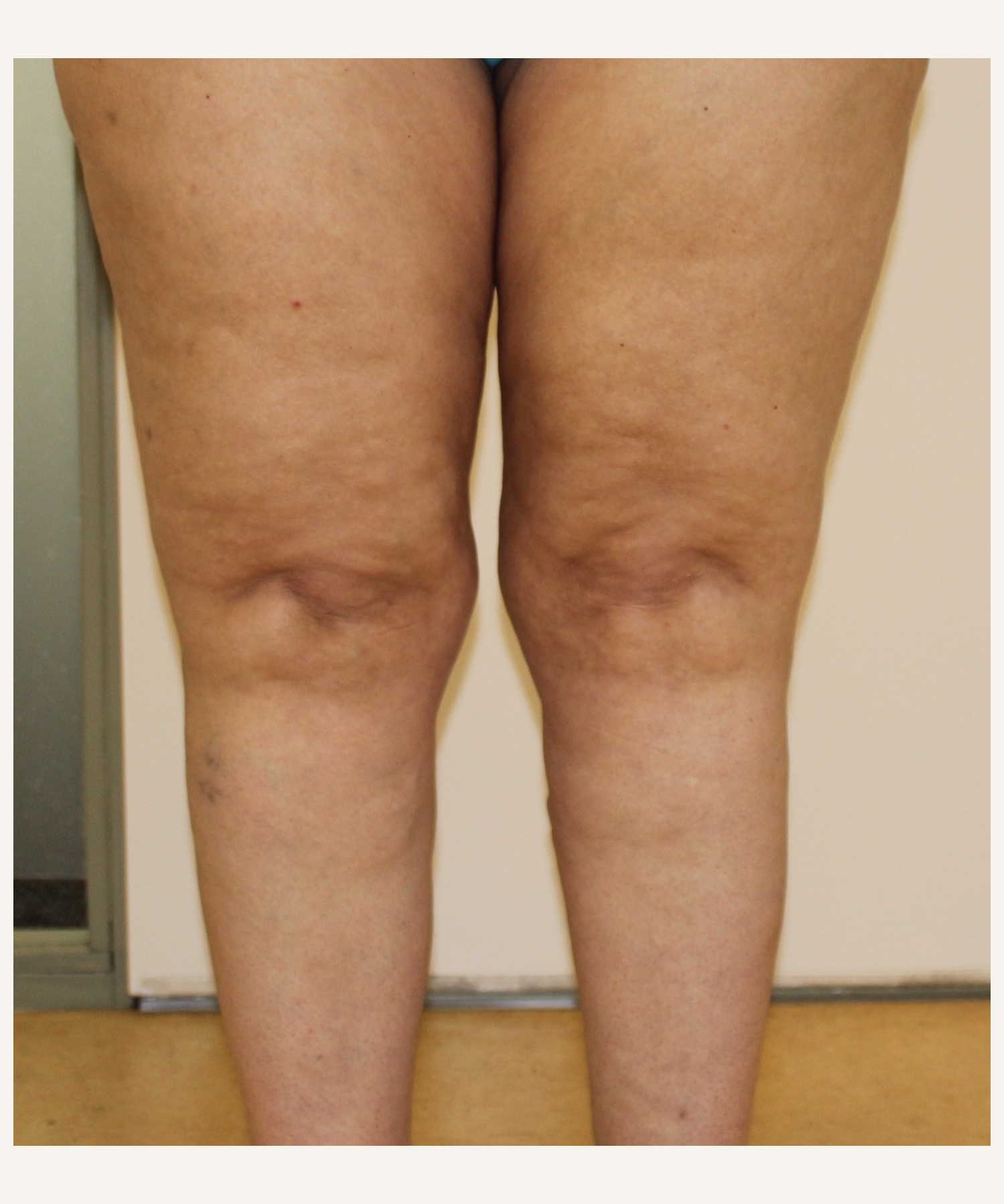 LPG Endermologie van de benen, voor behandeling
