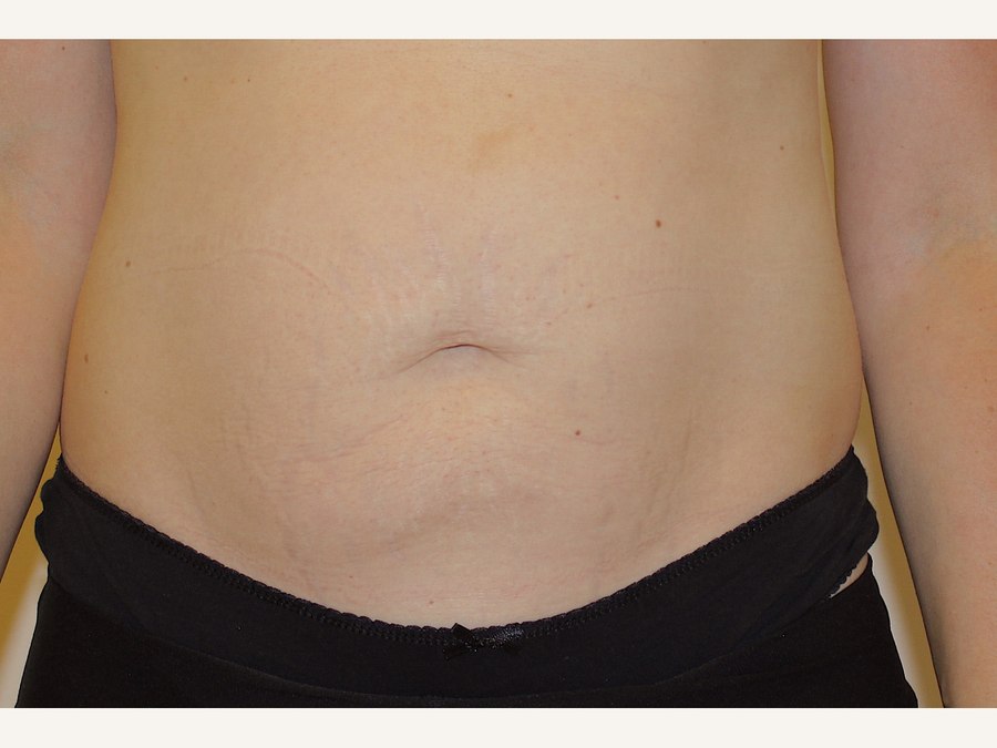 Buik: LPG en microneedling, na behandeling