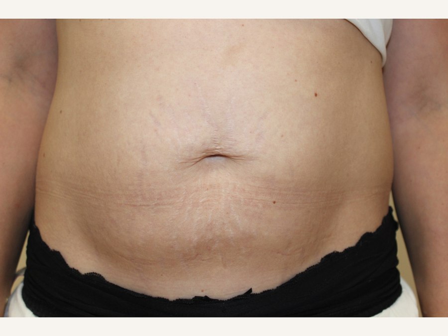 Buik: LPG en microneedling, voor behandeling