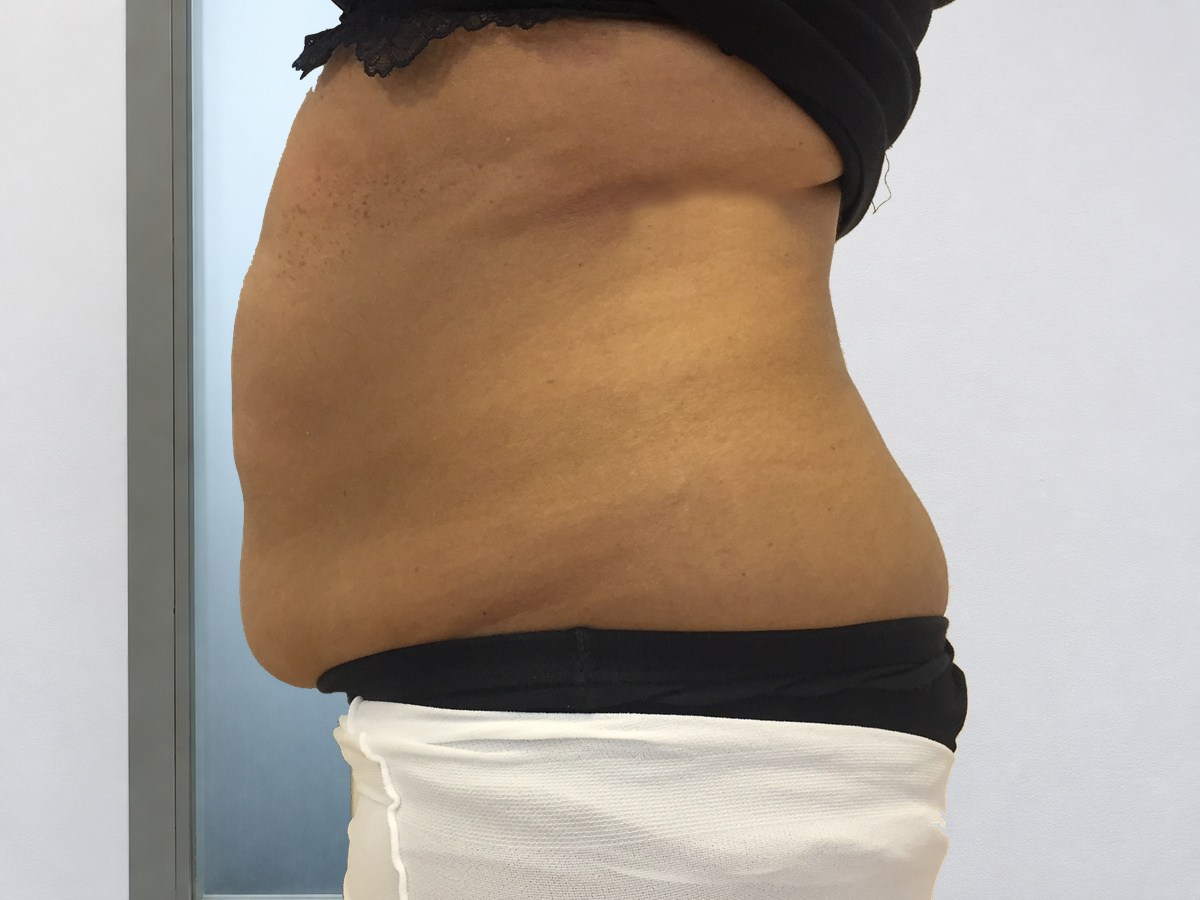 LPG Endermologie van de buik, na behandeling