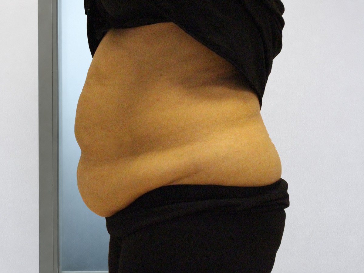 LPG Endermologie van de buik, voor behandeling