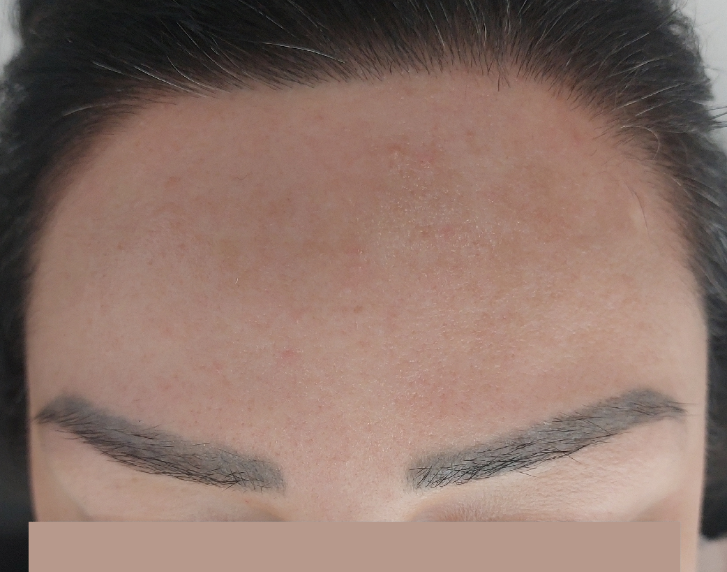 Melasma in het gezicht, na behandeling