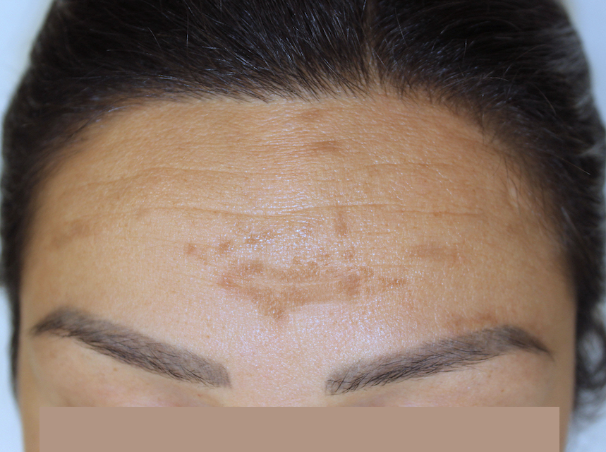 Melasma in het gezicht, voor behandeling