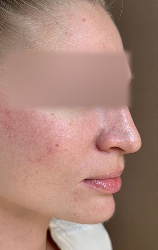 Roodheid bij rosacea na behandeling