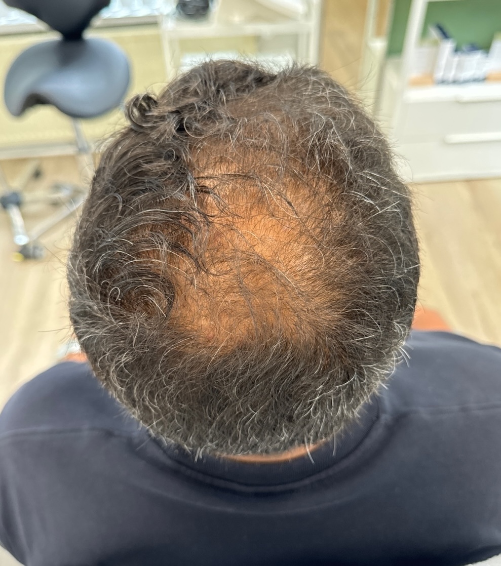 XL Hair voor behandeling