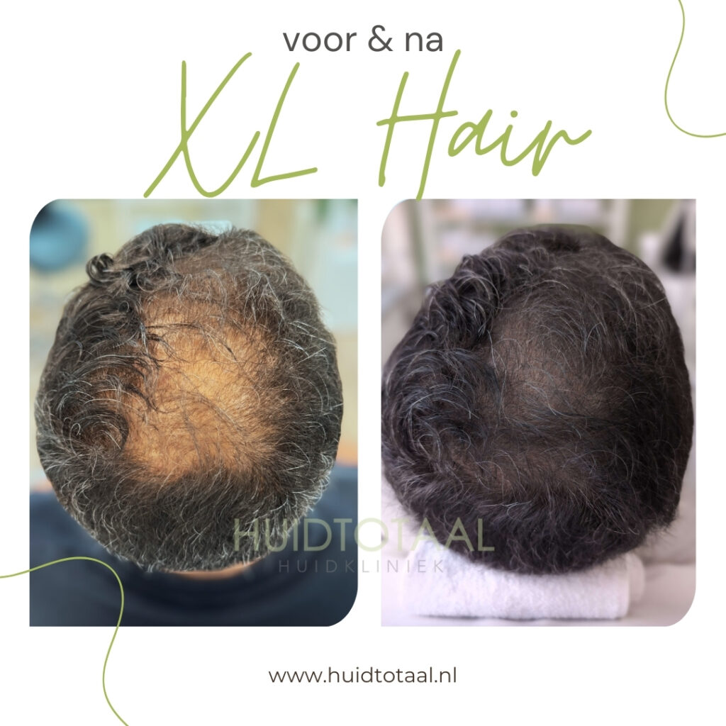 XL Hair voor-na